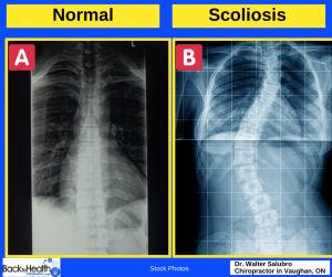 scoliosis adolescent idiopathic cobb