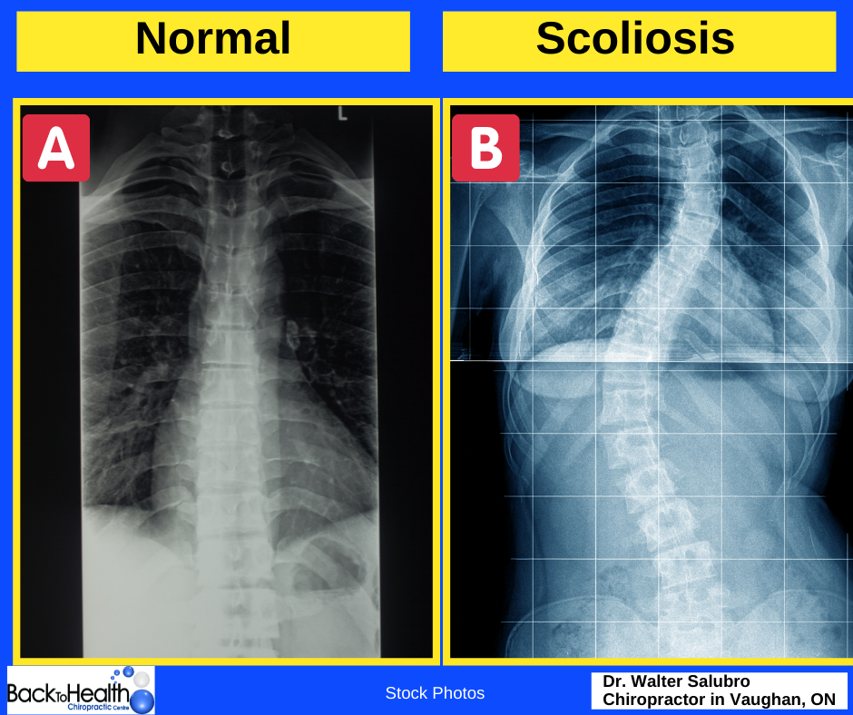 Breaking Down the Braces Used to Correct Scoliosis – Chiropractic BioPhysics